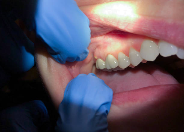 Best Emergency Wisdom Teeth Removal in Van Buren, AR